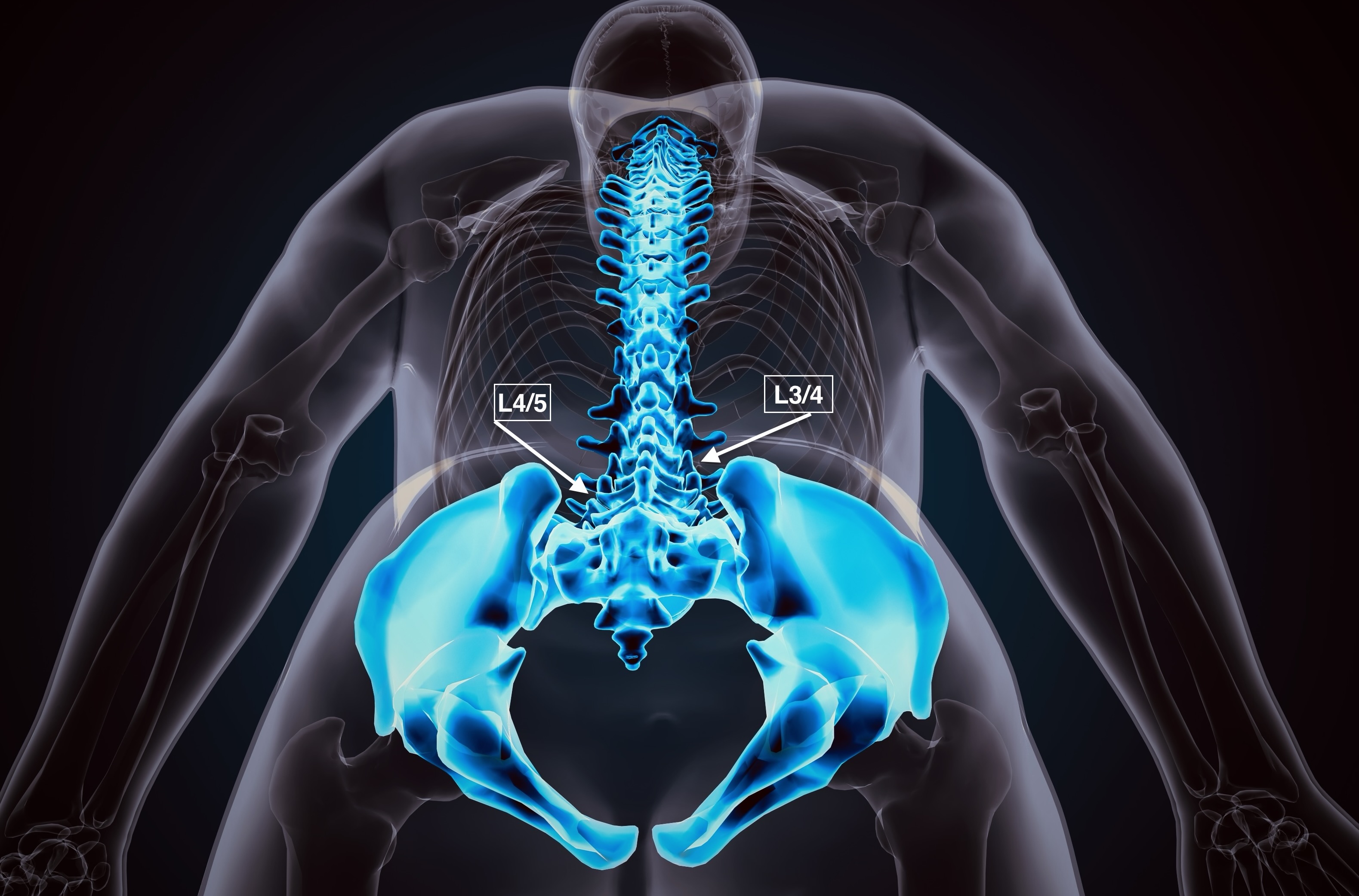 Transforaminale epidurale Injektion (Lendenwirbelsäule)